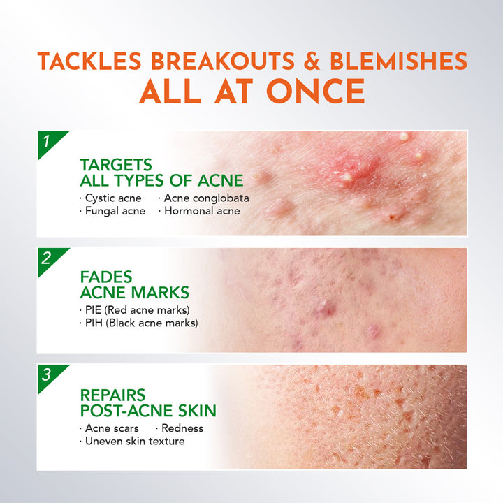 Acneplus ACNEPLUS Spot Care Pro Serum – You-Beauty-Global